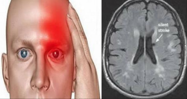 11 опасных признаков, которые указывают, что у вас «тихий» инсульт и еще один последует вскоре