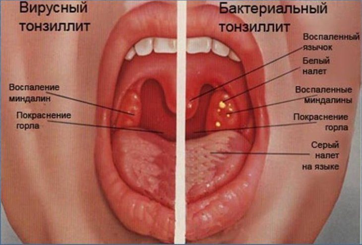 Как избавиться от ангины и боли в горле быстро? Старый домашний рецепт-вылечит на раз, два…Видео-всё про ангину! Как избавиться от ангины и боли в горле быстро? Старый домашний рецепт-вылечит на раз, два…Видео-всё про ангину!