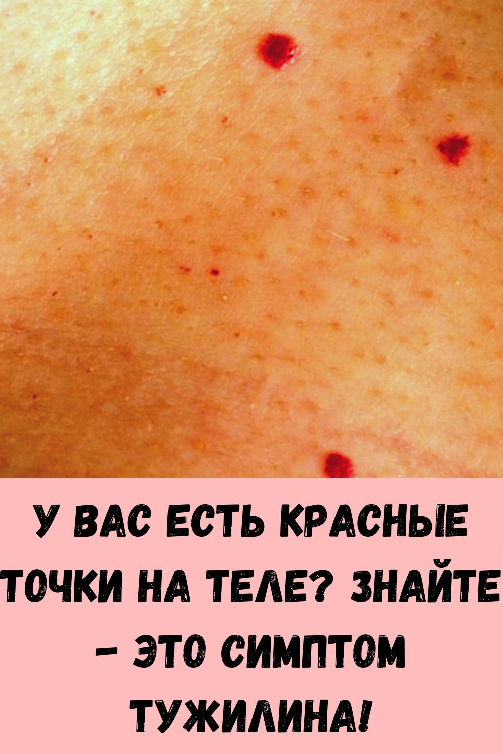 У вас есть красные точки на теле? Знайте - это симптом Тужилина!