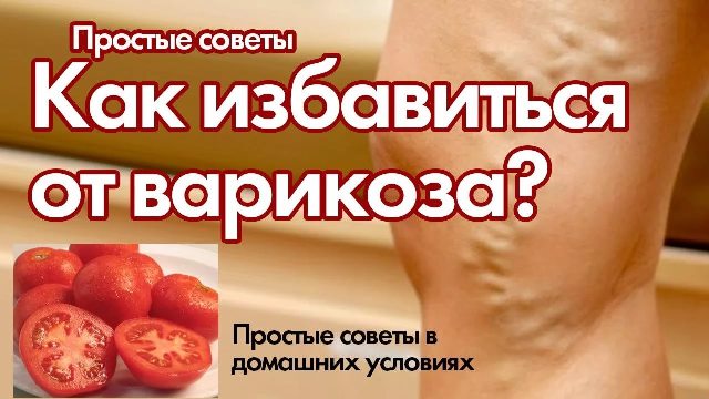 Лучшие народные рецепты от варикоза — самые эффективные народные средства!