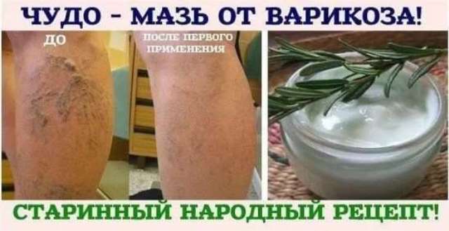 Лучшие народные рецепты от варикоза — самые эффективные народные средства!