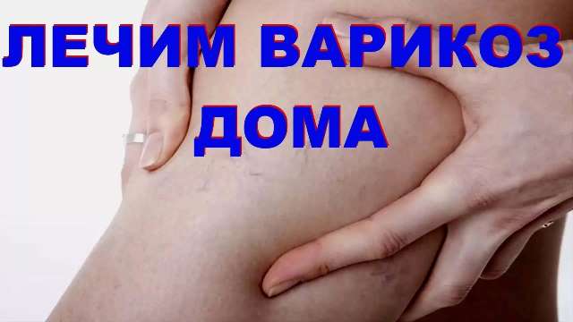 Лучшие народные рецепты от варикоза — самые эффективные народные средства!