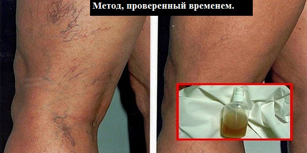 Этот бальзам из натуральных компонентов — лучший способ убрать сосудистую сетку и вернуть коже красоту!