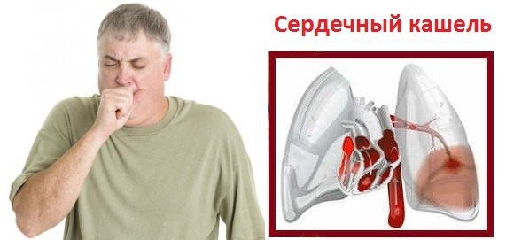 Что такое сердечный кашель,и как не спутать его с простудой