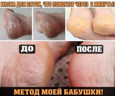 МАСКА ДЛЯ ПЯТОК, ЧТО ПОМОГАЕТ ЧЕРЕЗ 2 МИНУТЫ! МАСКА ДЛЯ ПЯТОК, ЧТО ПОМОГАЕТ ЧЕРЕЗ 2 МИНУТЫ!