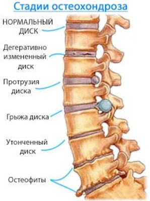 Стадии остеохондроза