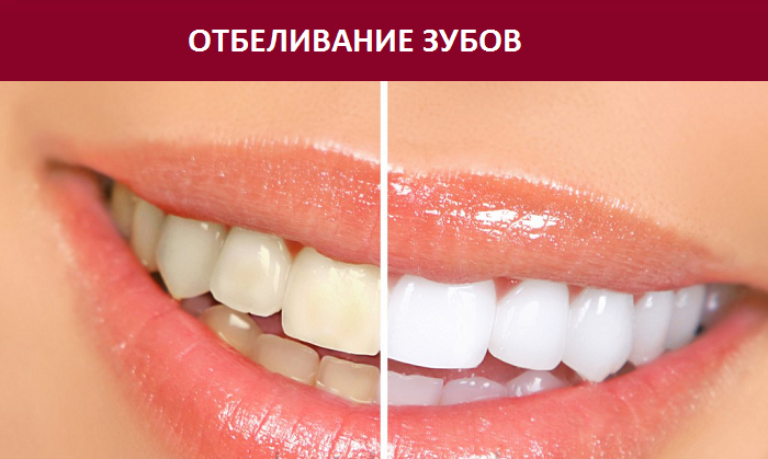 7 простых способов отбелить зубы